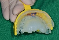 product_Immediate implant restoration06